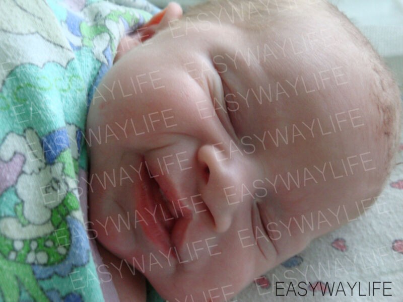 Рождение ребенка с расщелиной губы и мягкого нёба рис 1